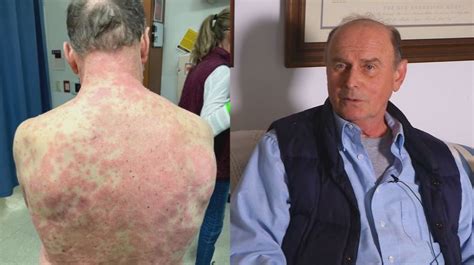 Goochland County Man Suffers Rare Severe Reaction To Covid 19 Vaccine Goochland County Man Suffers Rare Severe Reaction To Covid 19 Vaccine