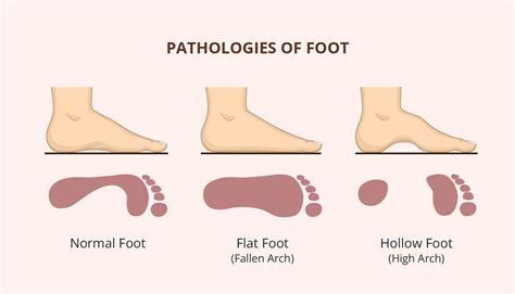 Good Feet Vs Fleet Feet